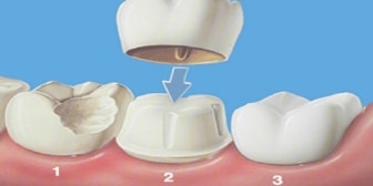 dental crowns in whitby- Emergecy dental office Whitby Smile Centre specialist in both family and cosmetic dentistry. 