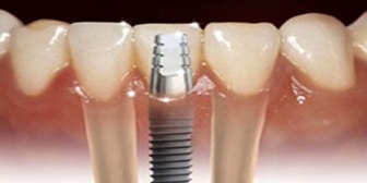 dental implants in whitby-Whitby Smile Centre your local emergency dental office specialist in both family and cosmetic dentistry.
