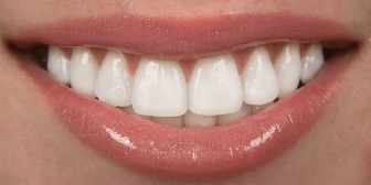 dental veneer in whitby- Whitby Smile Centre family and cosmetic dentistry.