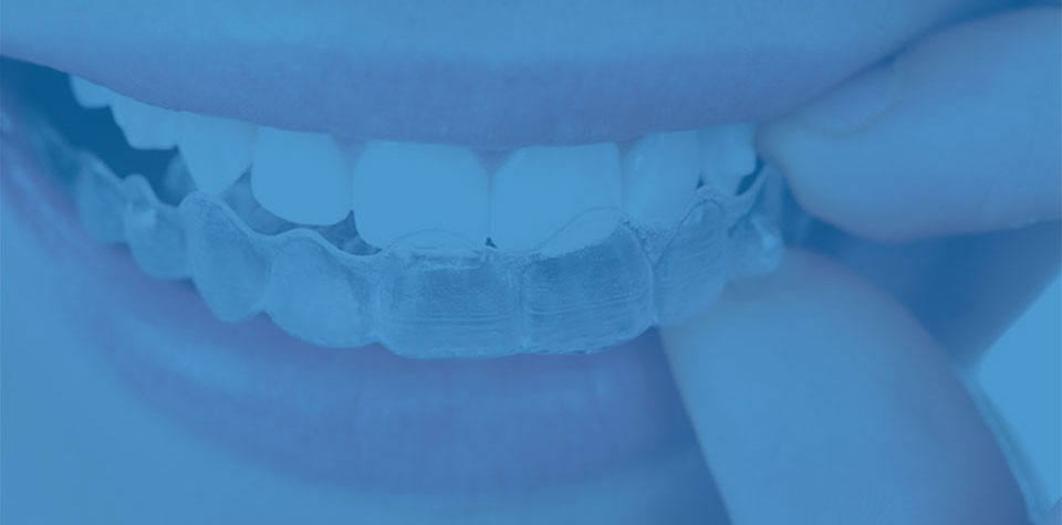 invisible clear braces and clear aligners at Whitby smile centre.