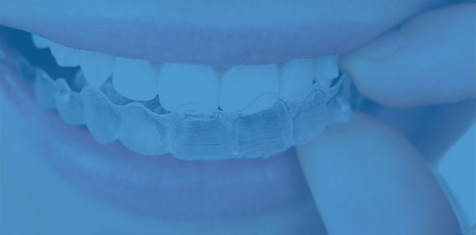 Clear Braces: Aligners & Teeth Straightening