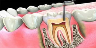 root canal therapy in whitby- emergency dental office- whitby smile centre, family and general dentistry. 