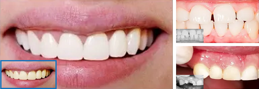 invisible braces- cosmetic denistry and orthodontics at Whitby Smile Centre.