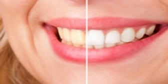 teeth whitening in whitby- emergency dental office- Whitby Smile Centre, family and cosmetic dentistry